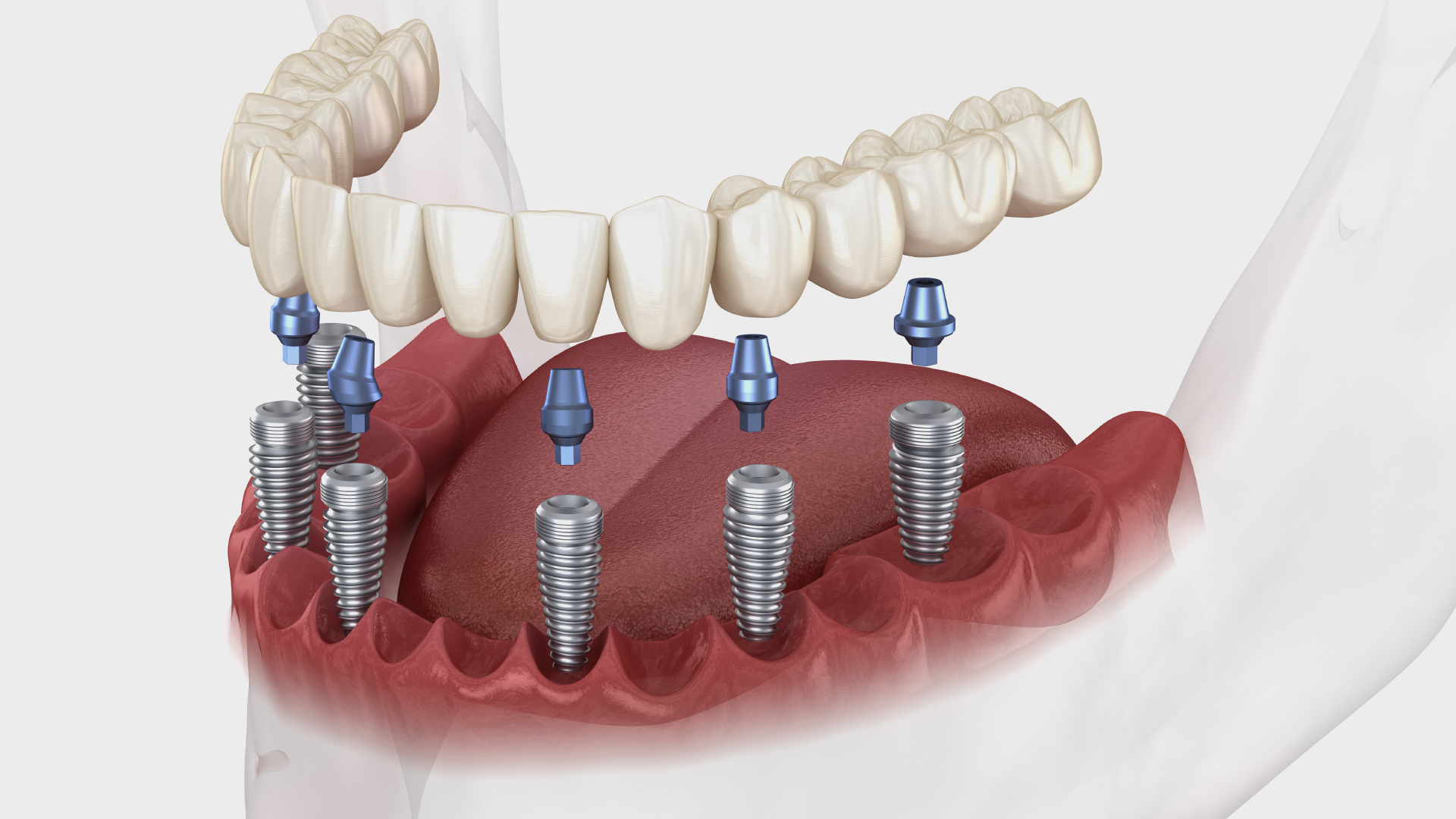Corticobasal Implants